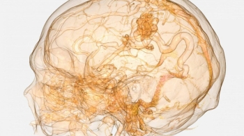 Arteriyovenöz Malformasyon (AVM)