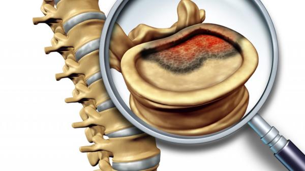 Omurga/Omurilik Tümörleri